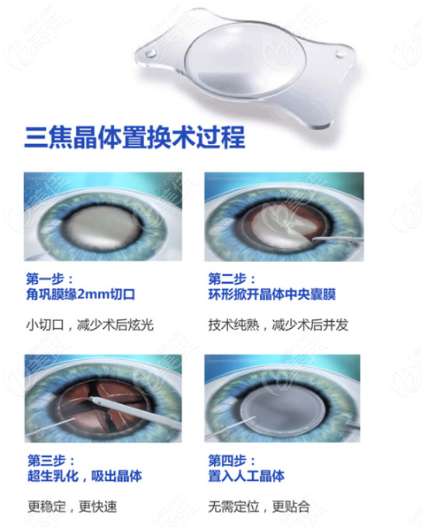 白内障三焦点人工晶体植入过程和步骤