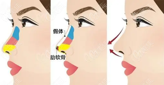 鼻整形图示236z.com