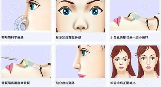 鼻修复