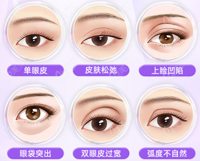 雷蕾医生做双眼皮技术好吗
