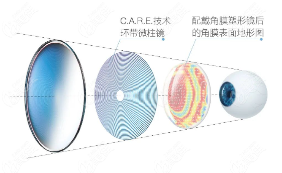 蔡司小乐园镜片设计原理 蔡司小乐园镜片设计原理