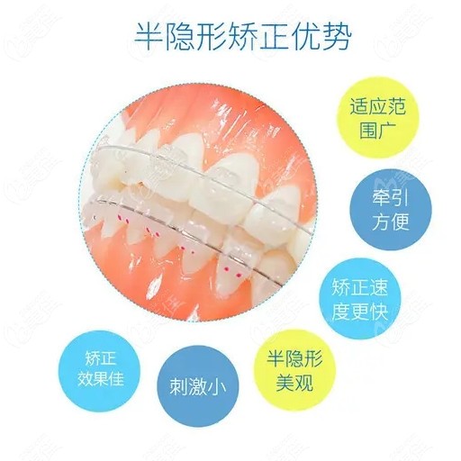 银川牙博士口腔做牙齿矫正的优势比较多