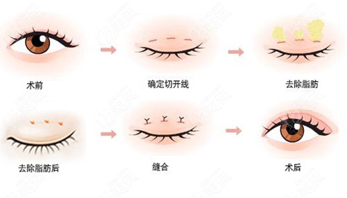 张亚东医生做眼部整形的手术原理图
