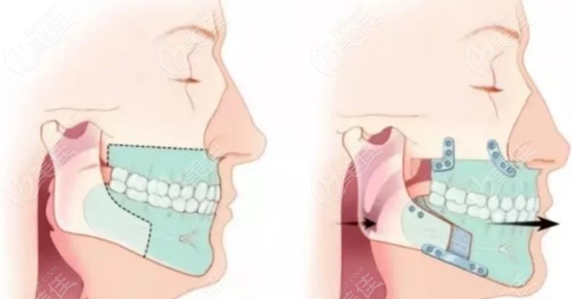 正颌手术和正畸的区别