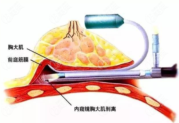 <!--<i data=20240703-sp></i>-->假体隆胸技术好