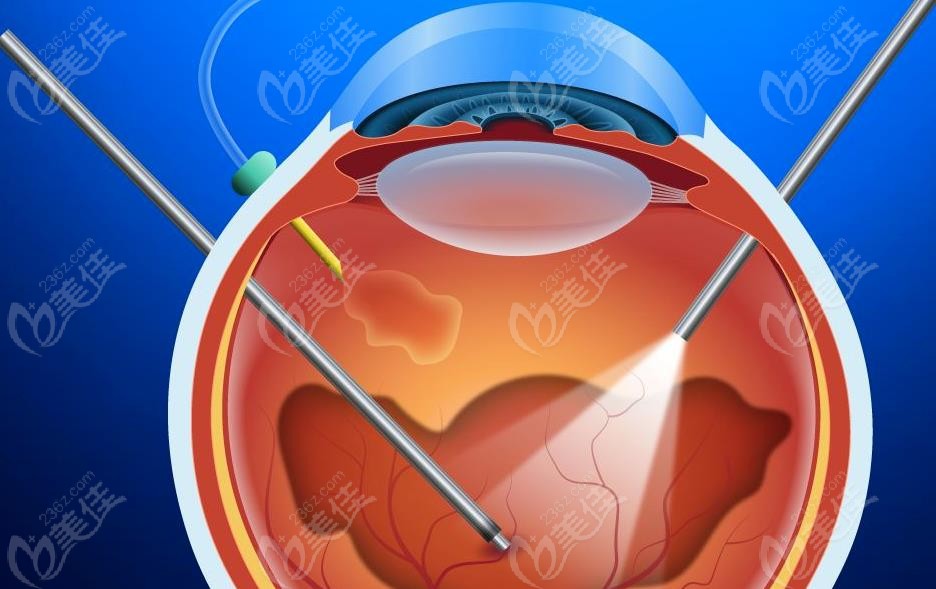 视网膜脱落做手术需要多久恢复以及恢复期注意事项