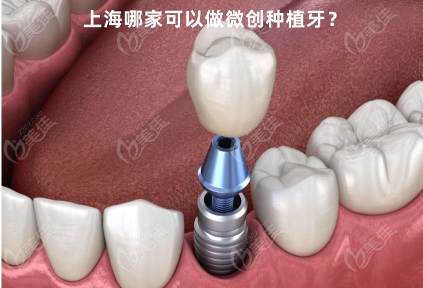 <!--<i data=20240703-sp></i>-->哪家可以做微创种植牙236z.com