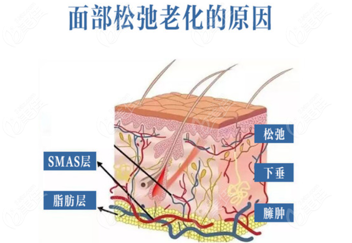 成都李辉医生做面部拉皮怎么样