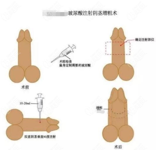 丁丁注射玻尿酸增粗能增多少厘米m.236z.com