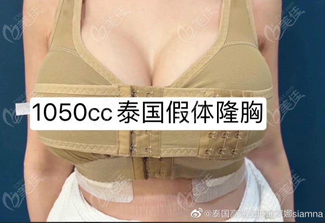 泰国暹罗娜整形医院1050cc假体隆胸图