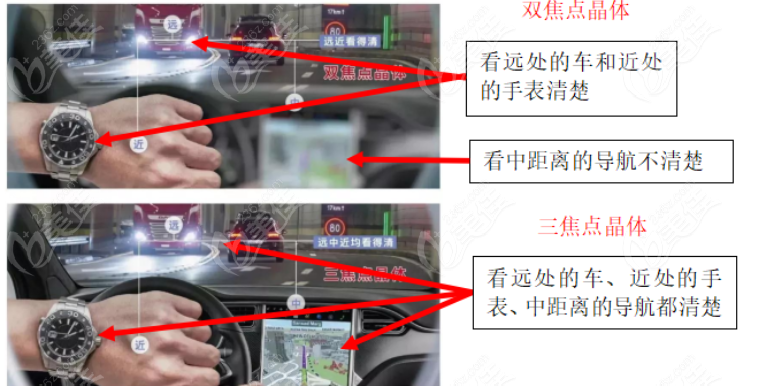 双焦晶体和三焦晶体哪个视觉质量好
