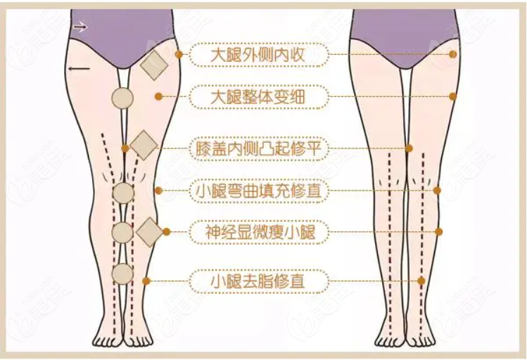上海丽质卢九宁形体矫正中心直腿术怎么样