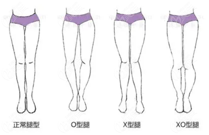 上海卢九宁形体矫正中心O型腿X型腿矫正怎么样