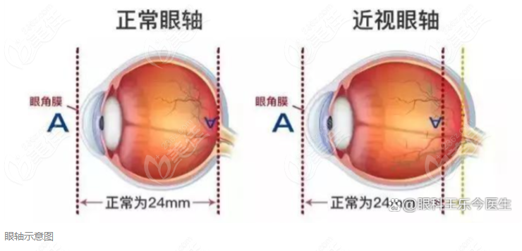 近视眼眼轴怎么,近视眼眼轴怎么变回原来的眼轴