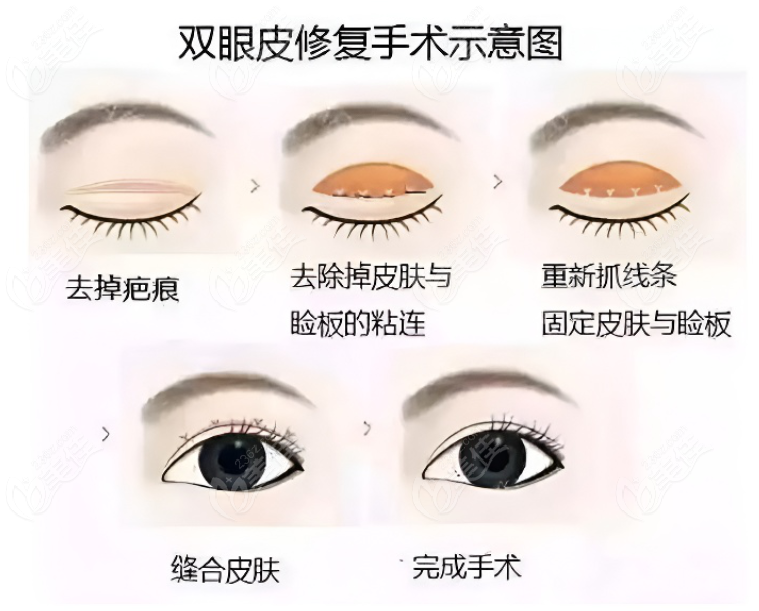 上海爱尚丽格双眼皮修复怎么做