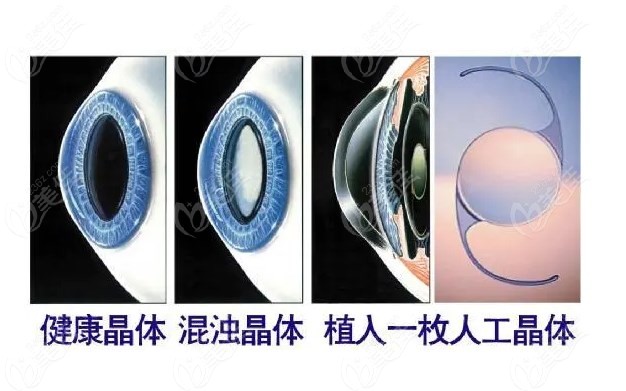 免費的白內(nèi)障人工晶體好不好