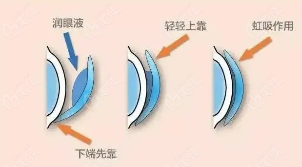 角膜塑形镜佩戴方式
