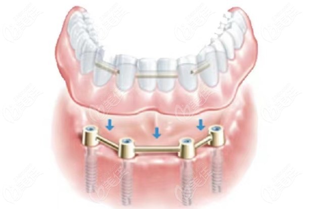 杆卡半固定种植牙图片
