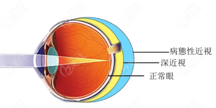 深近视、病态性近视与正常的眼部形态对比236z.com