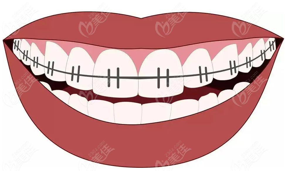 南方口腔牙齿矫正技术