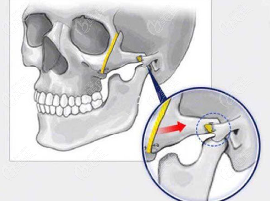 颧骨颧弓整形手术图示