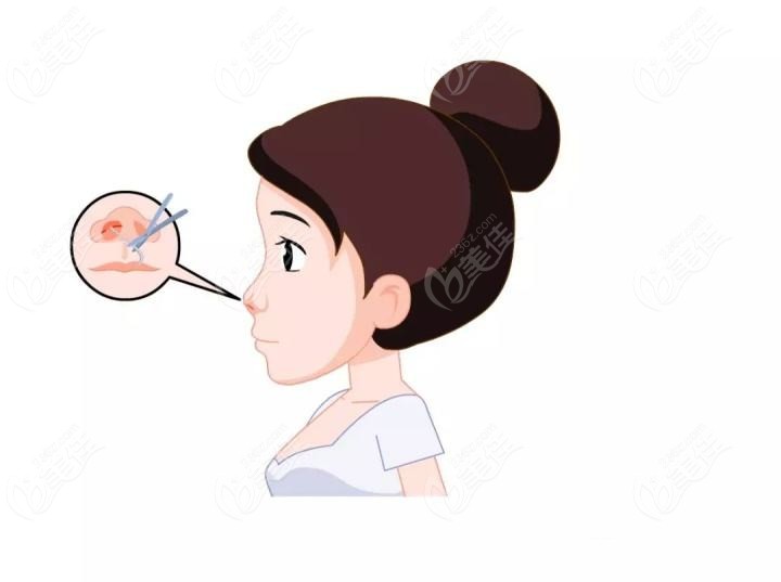 段焘隆鼻技术怎么样？肋骨鼻做的好还自然