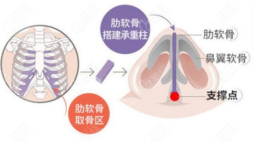 段焘肋骨鼻子技术优势图