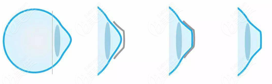 OK镜比rgp控制近视成效好