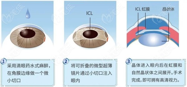 上海新视界眼科李海燕做icl晶体植入手术怎么样