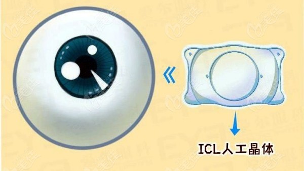 上海新视界眼科icl晶体植入术价格不算贵