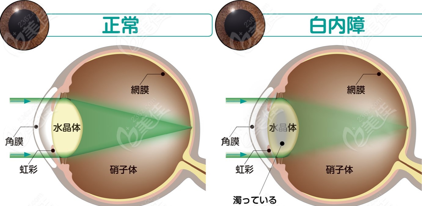 昆明普瑞眼科医院叶计芬医生做白内障手术好