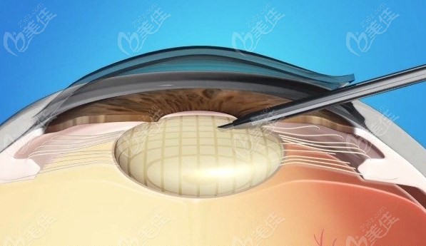 昆明普瑞眼科白内障价格