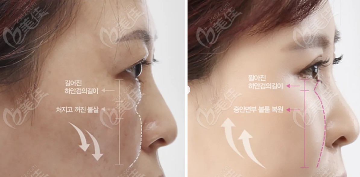 韩国大眼睛整形医院高汉雄医生下眼睑提升前后对比图片