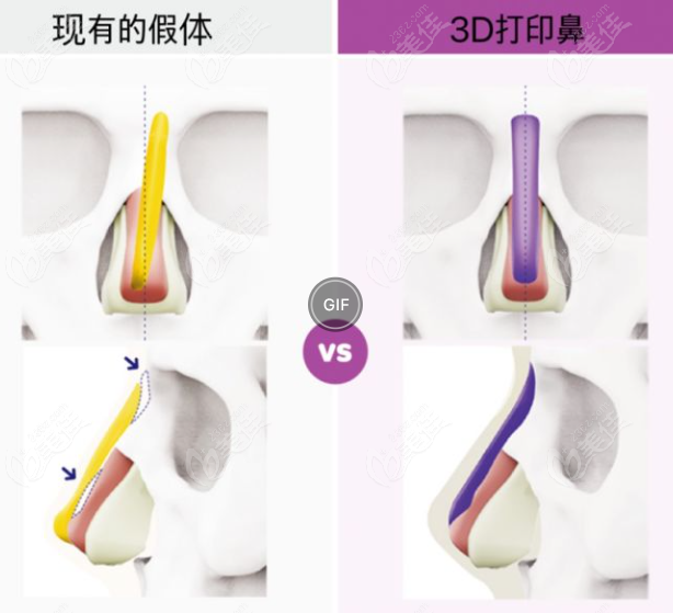 3d打印隆鼻对比传统假体隆鼻