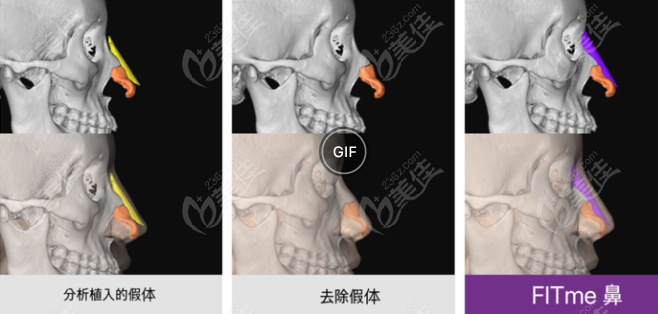 3D打印隆鼻手术图示236z.com