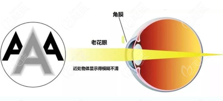 白内障植入蔡司三焦点晶体出现后发障原因