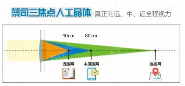 白内障植入蔡司三焦点人工晶体优势