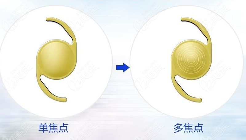 白内障人工晶体