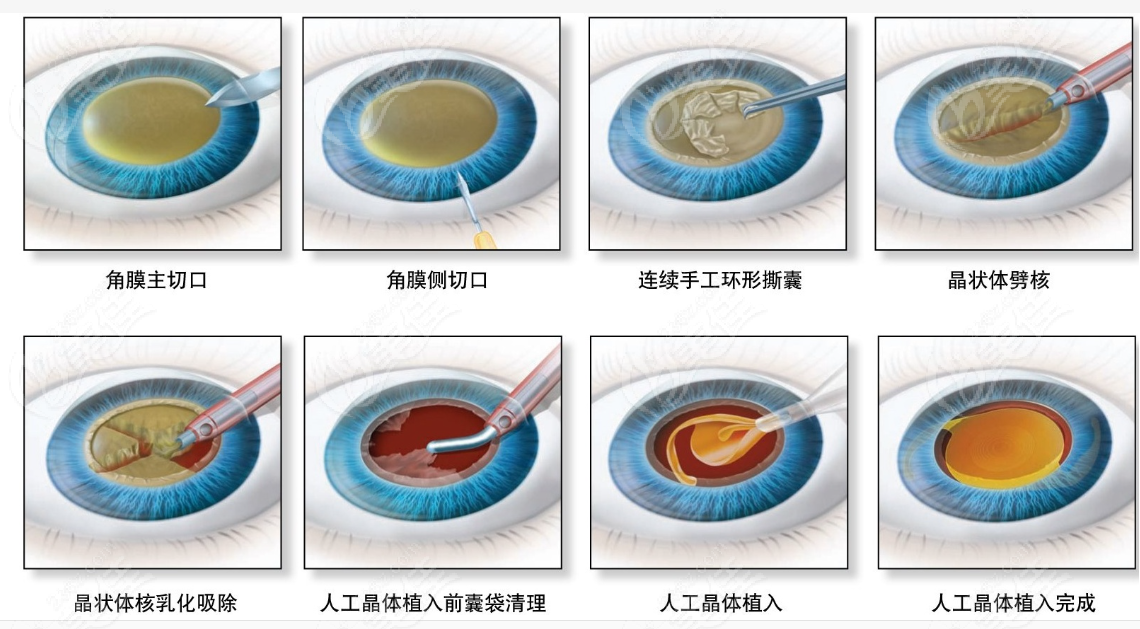 郑州尖峰眼科医院白内障过程和步骤