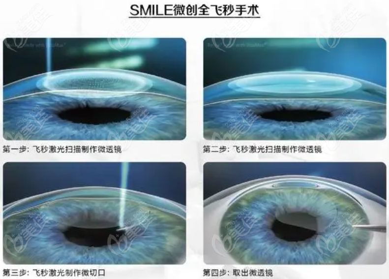 全飞秒激光近视手术236z.com