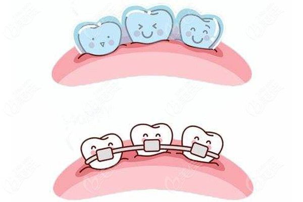 西诺口腔做牙齿矫正的优势和手术方式不同