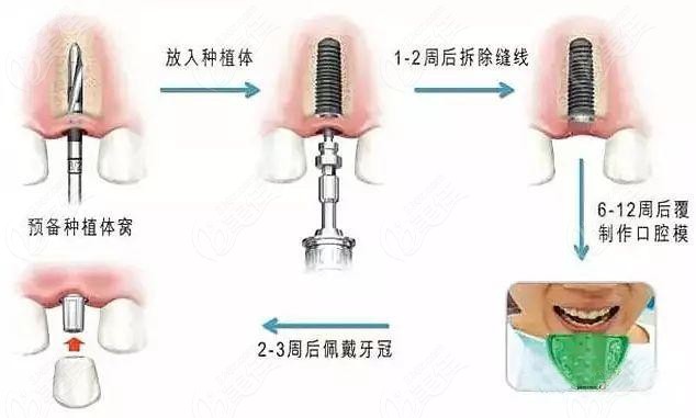 赤峰西诺口腔做种植牙的优势点www.236z.com