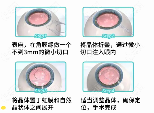 <!--<i data=20240703-sp></i>-->做近视晶体植入手术过程
