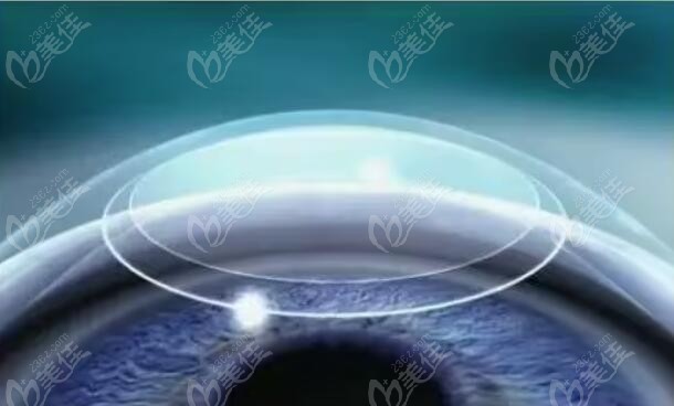 做了白內(nèi)障晶體為什么不建議再做激光（236z.com）