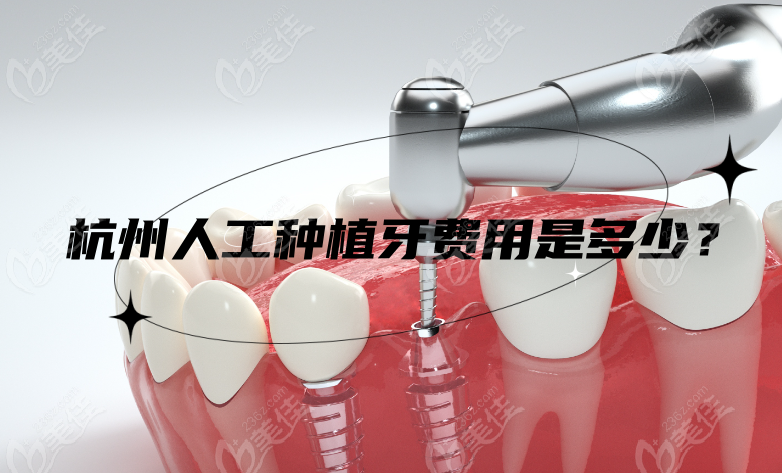 杭州人工种植牙费用是多少？www.236z.com