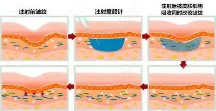 艾维岚童颜针注射过程