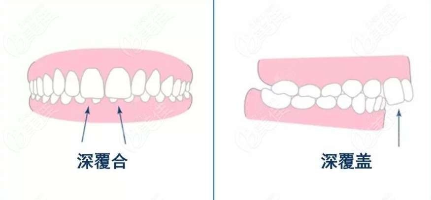 上海深覆合矯正做得好的醫院有哪些