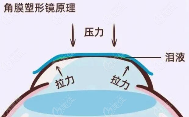 ok镜戴了一年度数增长了50度都属于正常现象-美佳