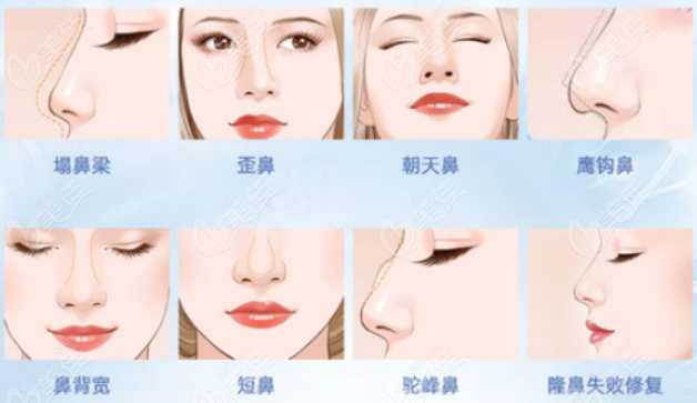 成美隆鼻手术对比
