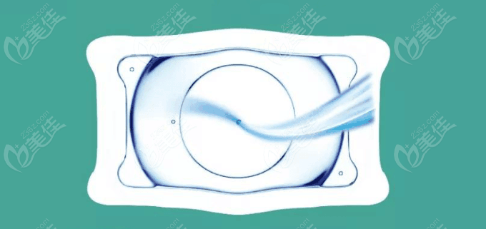 白內(nèi)障不動手術可以嗎